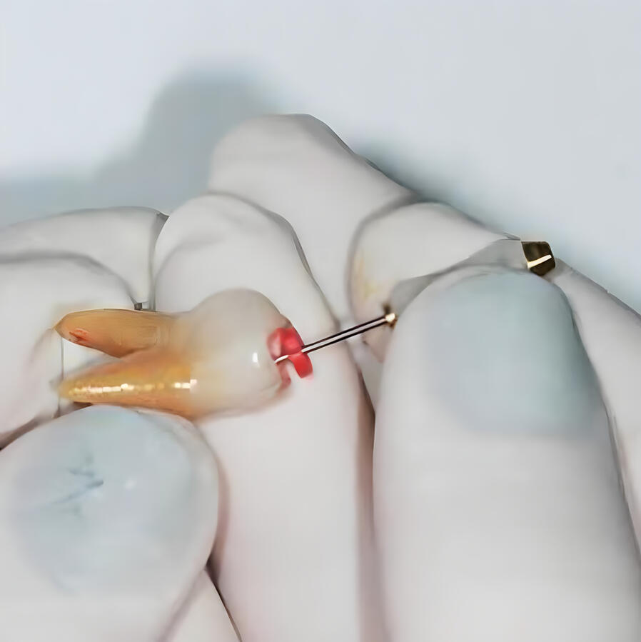 Endodontia de Dente Decíduo (Tratamento de Canal)